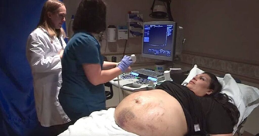 Její břicho bylo obrovské a všude měla modřiny.  Lékaři udělali ultrazvuk a zůstali v šoku! Náhledový obrázek