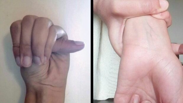 Zvládnete rukama tyto pohyby? Mohou být příznakem vzácného syndromu, který může ohrozit i srdce! Náhledový obrázek